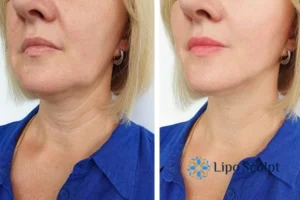 Double chin before and after Hi-Fu treatment 4 Book your double chin treatment Kenilworth today! We are here to help!