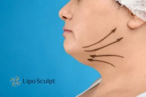 Double chin before and after Hi-Fu treatment 3 Boost your confidence with a Double chin treatment Kenilworth