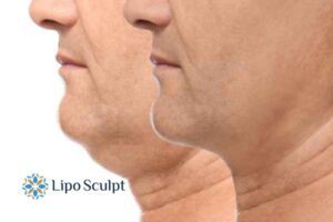 Double chin before and after Hi-Fu treatment 2 Double chin treatment Kenilworth from Lipo Sculpt - feel more confident today!