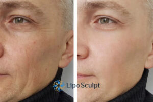 How to Fight Aging Symptoms 3 Fight Aging Symptoms Kenilworth With HIFU and Morpheus8 Today!