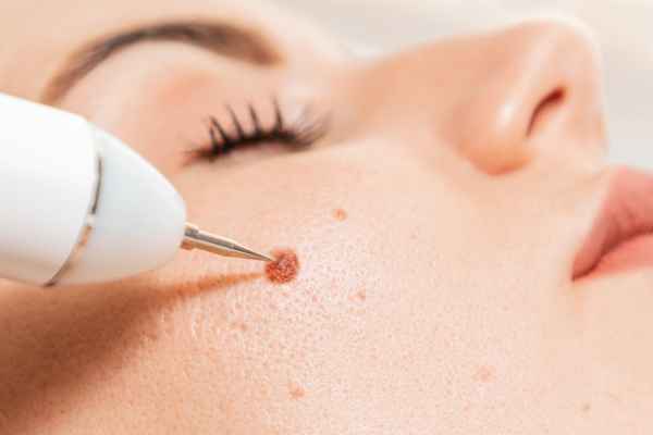 CryoPen: 5 Skin Concerns It May Be Used to Treat 3 What actually happens during a CryoPen treatment Kenilworth?