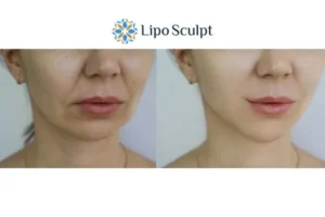 Explaining Morpheus8 And What It Can Do For You 2 Do you want to boost your self confidence? Give Morpheus8 Kenilworth a try today!