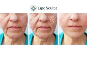 Explaining Morpheus8 And What It Can Do For You 3 Boost your confidence with Morpheus8 Kenilworth call our team today!