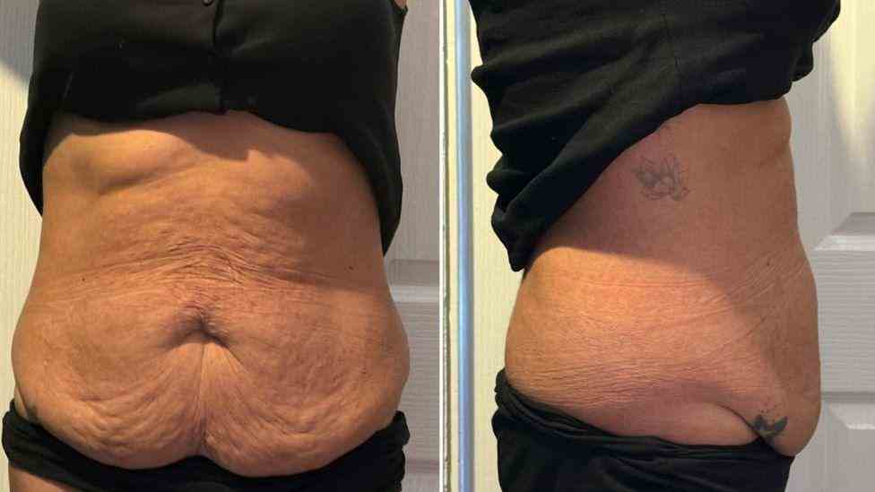 Lost the Weight but Not the Loose Skin? What You Should Know 1 Is It Definitely Loose Skin Kenilworth?
