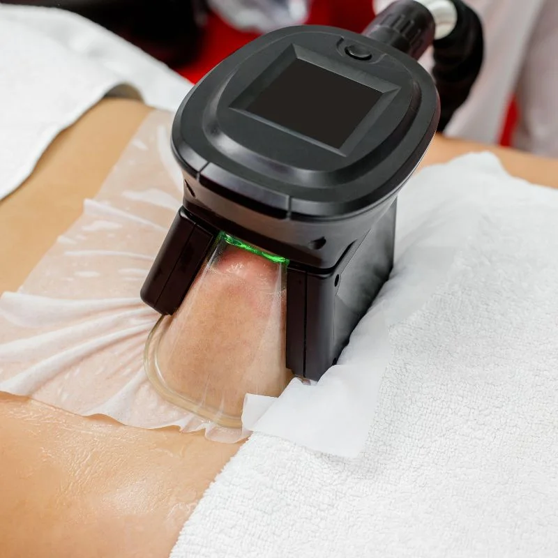 Fat Freezing treatment Kenilworth